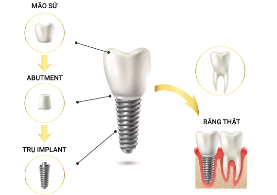 Trồng (cấy, làm, cắm) răng Implant NHA KHOA I-DENT công nghệ Pháp? An toàn, thẩm mỹ, không đau