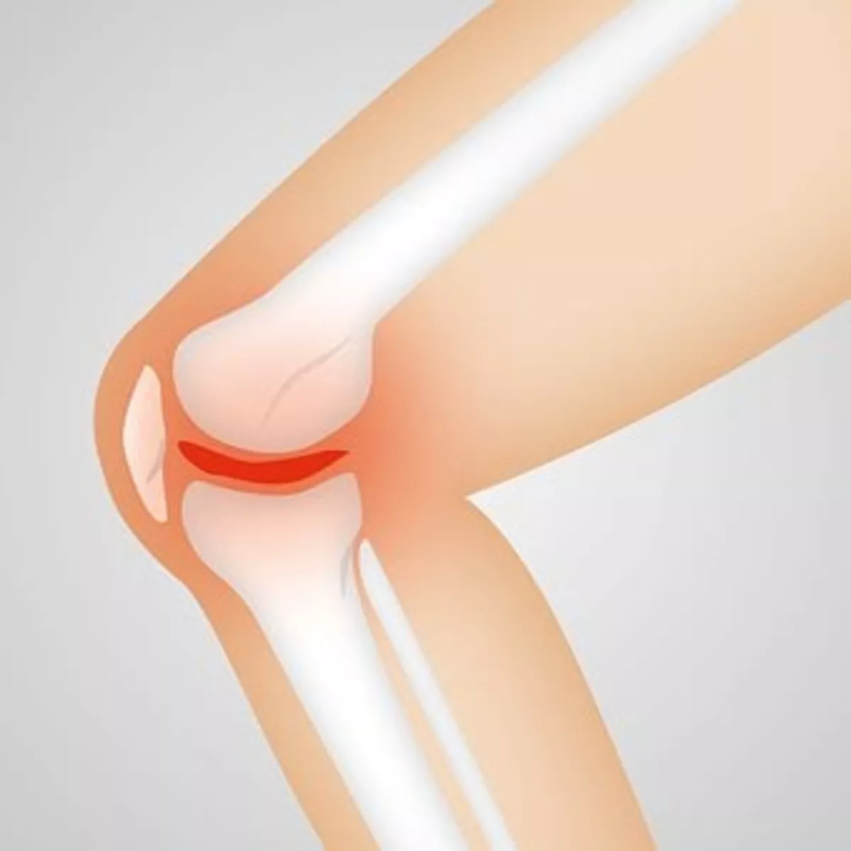 Knee Replacement Surgery